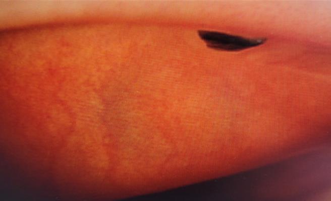 中秋烤肉突掀大风，28岁女子左眼随风吹入黄色小虫、铝箔纸、木炭，就医治疗已痊癒。（画面翻摄／纪爰高雄传真）