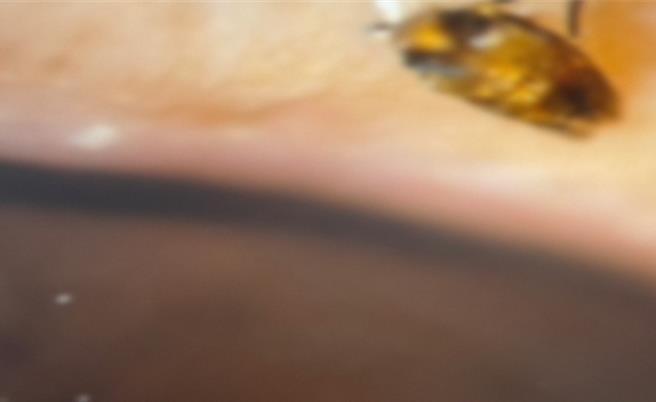 中秋烤肉突掀大风，28岁女子左眼随风吹入黄色小虫、铝箔纸、木炭，就医治疗已痊癒。（画面翻摄／纪爰高雄传真）