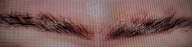 中秋烤肉突掀大风，30岁男子眉毛烧焦、皮肤也灼伤红肿、右眼随风吹入断裂铁丝，剧烈疼痛就医，经治疗已经恢復视力。（画面翻摄／纪爰高雄传真）