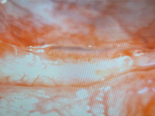 中秋烤肉突掀大风，30岁男子眉毛烧焦、皮肤也灼伤红肿、右眼随风吹入断裂铁丝，剧烈疼痛就医，还好经治疗已经恢復视力。（画面翻摄／纪爰高雄传真）