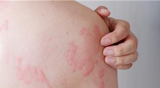 蕁麻疹發作！全台23％人中招 專家曝解癢新療法