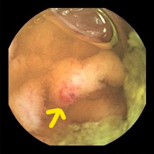 箭頭所指處即為出血處。（院方提供／李京昇台中傳真）