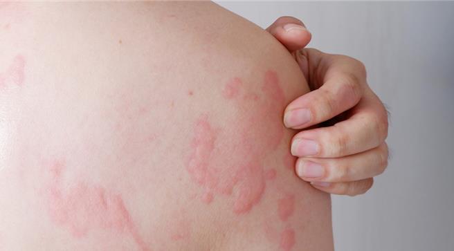蕁麻疹發病期間，會出現如蚊蟲叮咬的「紅、腫、癢」症狀。（示意圖：shutterstock／達志）
