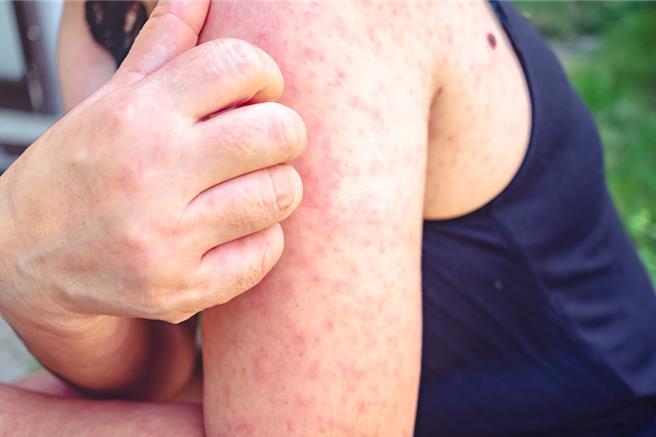 荨麻疹发病期间，会出现如蚊虫叮咬的「红、肿、痒」症状。（示意图：shutterstock／达志）