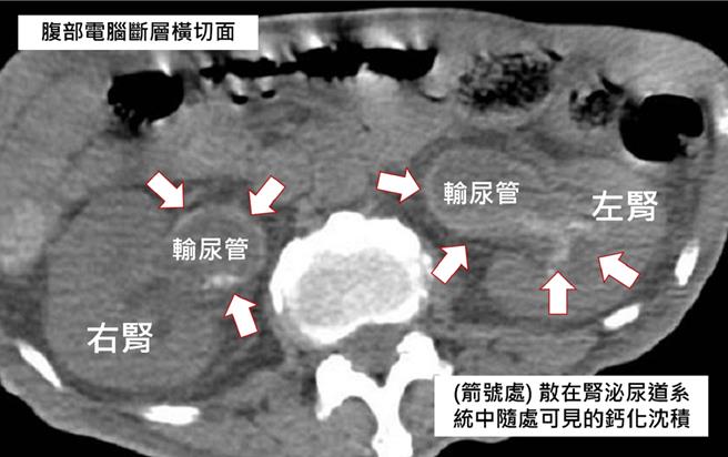 男子腹部電腦斷層發現，鈣的沈積物覆蓋在泌尿道系統的內部表面，有如一層蛋殼或敷上一層厚厚的水泥，輸尿管因此阻塞擴大，造成水腎及慢性發炎現象。（彰化醫院提供／葉靜美彰化傳真）