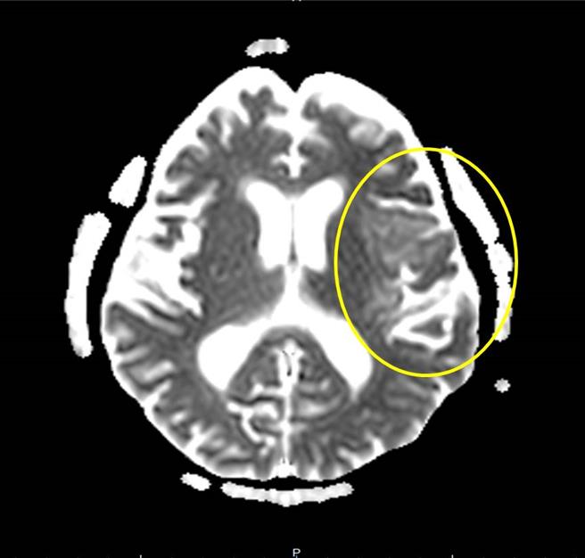 腦部核磁共振檢查診斷出腦炎狀況。（院方提供／李京昇台中傳真）