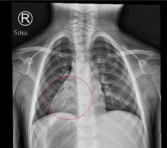 机率小于万分之一！3岁女童竟是「镜面人」 全身臟器位置都相反