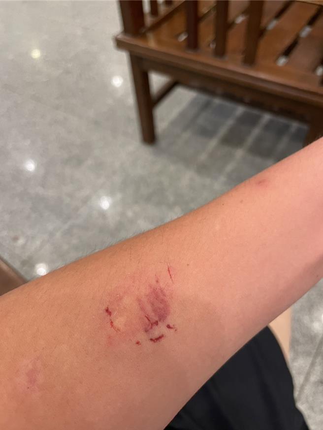 警員左手臂遭咬傷，所幸無大礙。（新店警分局提供）