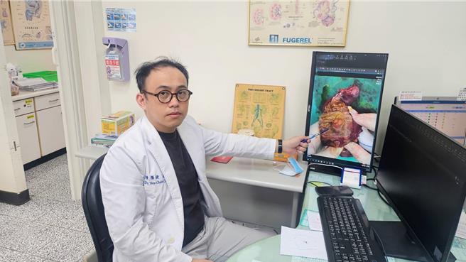 部苗医师陈雁捷指出惠普氏胰十二指肠切除术，除根治性切除外还需重建胰管、胆管与消化道，为肝胆胰手术中复杂且困难的术式。（部苗医院提供／谢明俊苗栗传真）