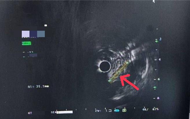 陈雁捷医师说明，可透过内视镜超音波做环状或线状扫描，进一步诊断肿瘤来源和侵犯深度。（部苗医院提供／谢明俊苗栗传真）