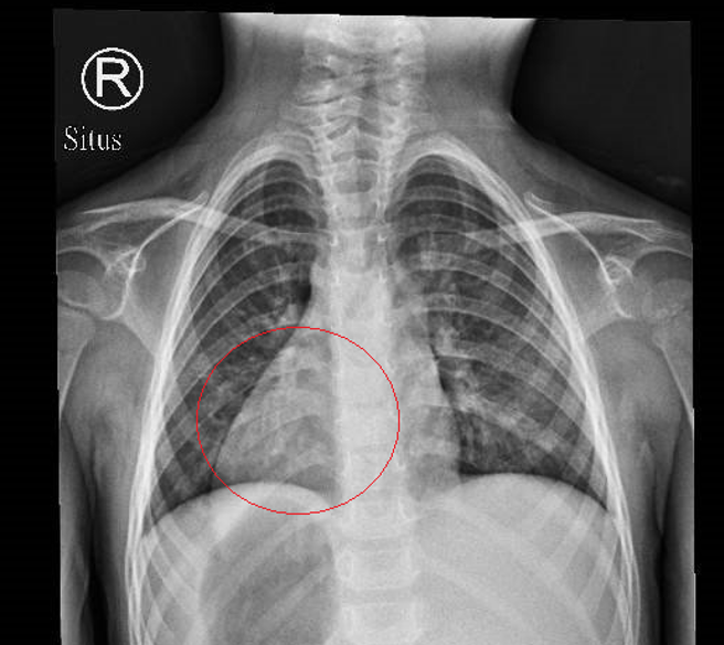 医师马瑞杉表示，女童的心臟偏右。（图／卫福部彰化医院提供）