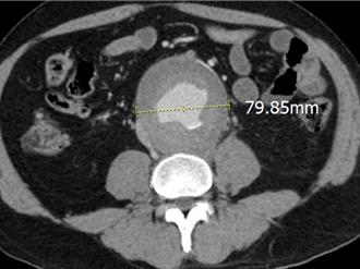 腰背痛竟是主動脈瘤作怪 醫師創新手術放「T分枝支架」保命