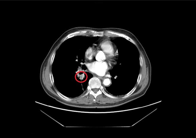 一位80岁病人以泰格莎治疗后，肿瘤缩小为1.3公分(红圈处)。（大千医院提供／谢明俊苗栗传真）