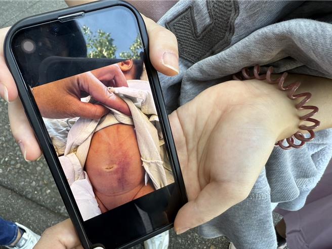 男婴妈妈秀出手机里儿子腹部大面积瘀青画面，说看了很心疼。(吕妍庭摄)
