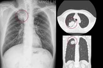 不菸不酒！50歲男「肺部6公分腫瘤」到處轉移 醫師分析最大原因