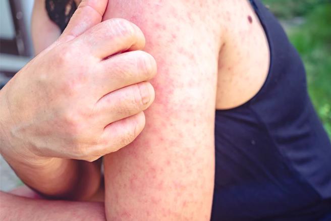 30歲男遊越南富國島染麻疹，疾管署提升旅遊疫情警示。（示意圖：shutterstock／達志）