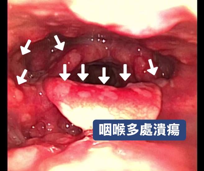 医师做鼻咽喉内视镜检查发现，女子整个喉咙都是大大小小的溃疡。（翻摄自李典宪 耳鼻喉科医师脸书）