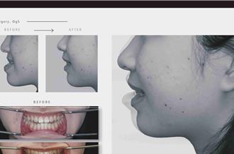 矯正＋正顎手術雙管齊下！女大生告別戽斗重拾自信