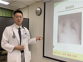 颱風過後感冒變重症！7旬翁咳血險喪命 醫曝1症狀最危險