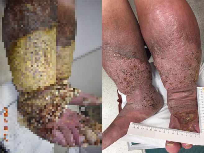 黃先生因不合腳的鞋，造成雙下肢水腫與硬厚黑痂皮覆蓋（左圖）；經過長時間治療，黃先生的傷口總算大幅改善（右圖）。(奇美醫院提供／曹婷婷台南傳真)