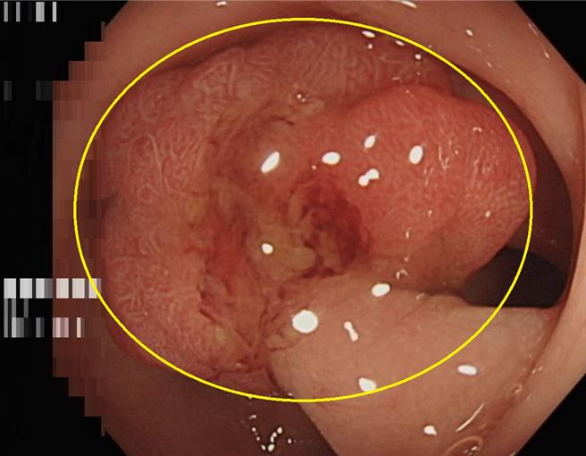 50歲林姓婦人經大腸鏡檢查影像報告瘜肉（黃圈處）屬於原位癌，幸好僅存在於表層黏膜尚未擴散。（長安醫院提供／馮惠宜台中傳真）