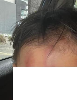 1歲兒常滿頭包！家長控虎尾托嬰中心虐童    社會處介入調查
