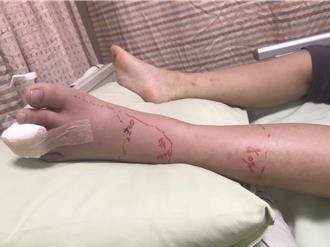 高雄國小學童倒垃圾遭蛇咬　校長：暫停學生外掃區作業