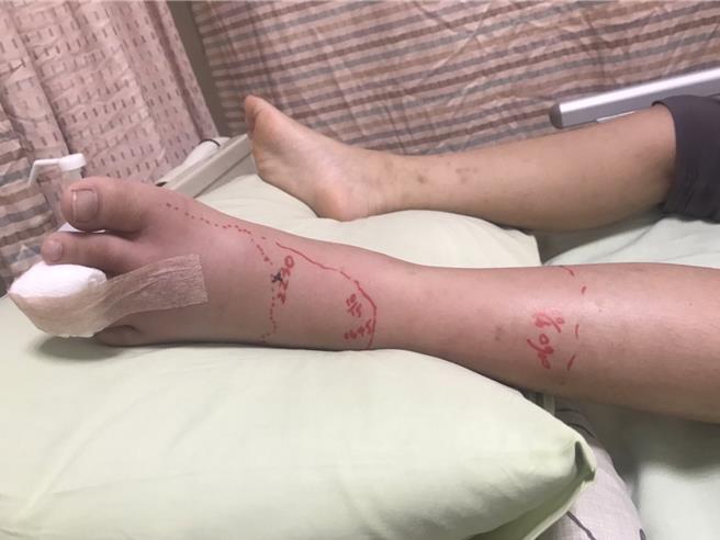 该童的左脚第3趾有2个咬痕，王校长说，事发地点在学校附近，第一次发生此事，学校也对学生进行防蛇宣导。（家属提供／林雅惠高雄传真）