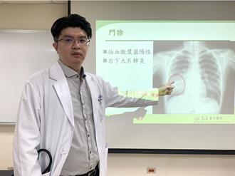 日本黴漿菌疫情升溫 女大生併發壞死性肺炎 右肺白一片