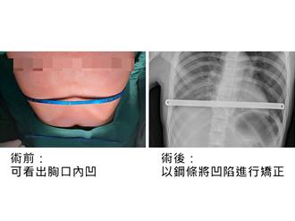 籃球夢不滅！泰北少年來台手術擺脫漏斗胸 重返球場