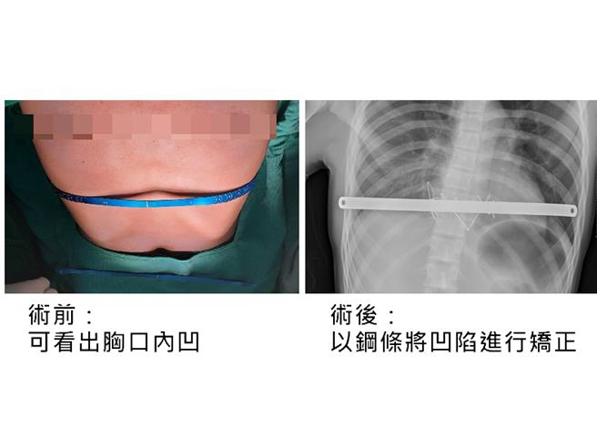 杨以信术前术后比较。(嘉义基督教医院提供／吕妍庭嘉义传真)