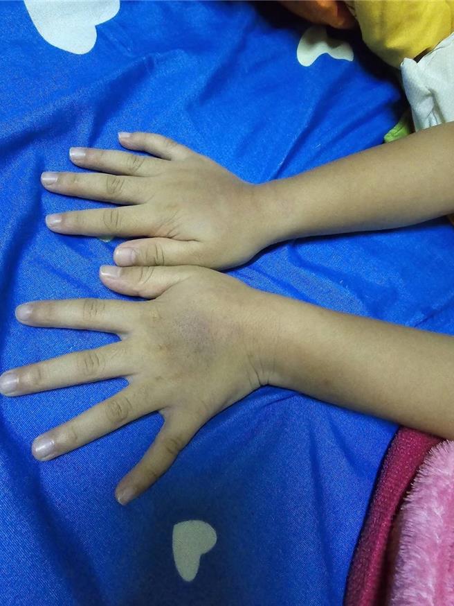一名女童的手背被打到瘀青。（王又民提供）