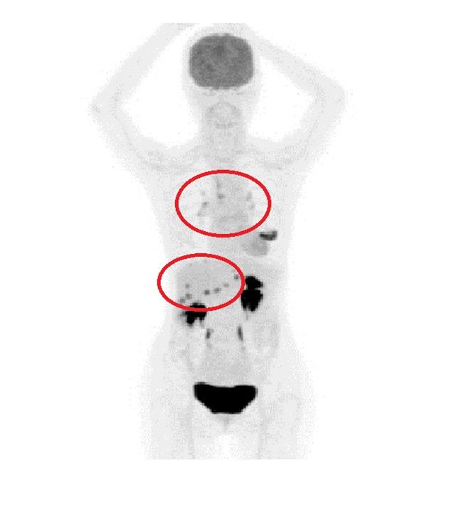 76歲的李女士在正子造影檢查下，發現多處轉移（紅圈處），適用CDK抑制劑幫助抑制癌細胞生長。（大千醫院提供／謝明俊苗栗傳真）