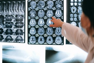 預防腦中風 遵守3原則