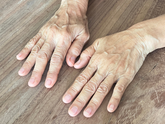 手背长斑是老化？恐藏3潜在问题：糖尿病常出现