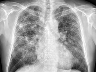 肺部肺結節滿天星！蘇一峰頭皮發麻：「手指1狀況」記得檢查