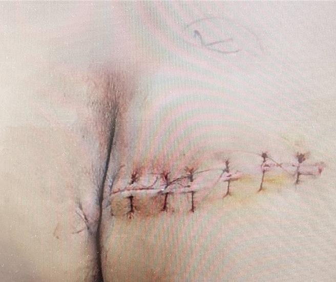 高姓男子从马桶上摔落后，一屁股坐在碎裂陶瓷上，造成右臀有1道长25公分、深5.5公分的撕裂伤，左臀部也有约5公分较浅的伤口，还好未伤及肛门。（翻摄画面／纪爰高雄传真）