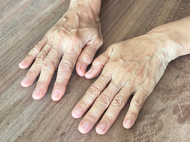 医师黄轩表示，当手背冒出色斑或色素沉淀时，要留意可能是潜在健康问题的预警信号。（示意图：shutterstock／达志）