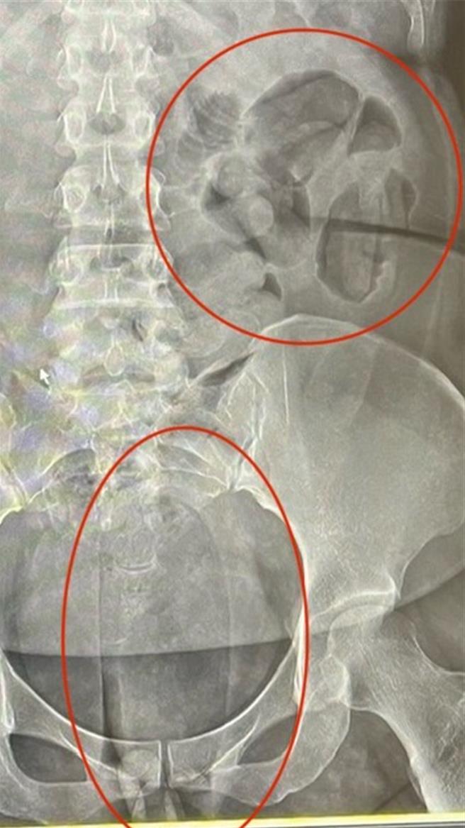 内政部警政署保安警察第三总队查获外籍女子以人体运毒方式夹带毒品海洛因与古柯碱等毒品重达5公斤，市值约3500万元。图为夹带毒品Ｘ光照。（保三总队提供／徐佑升基隆传真）