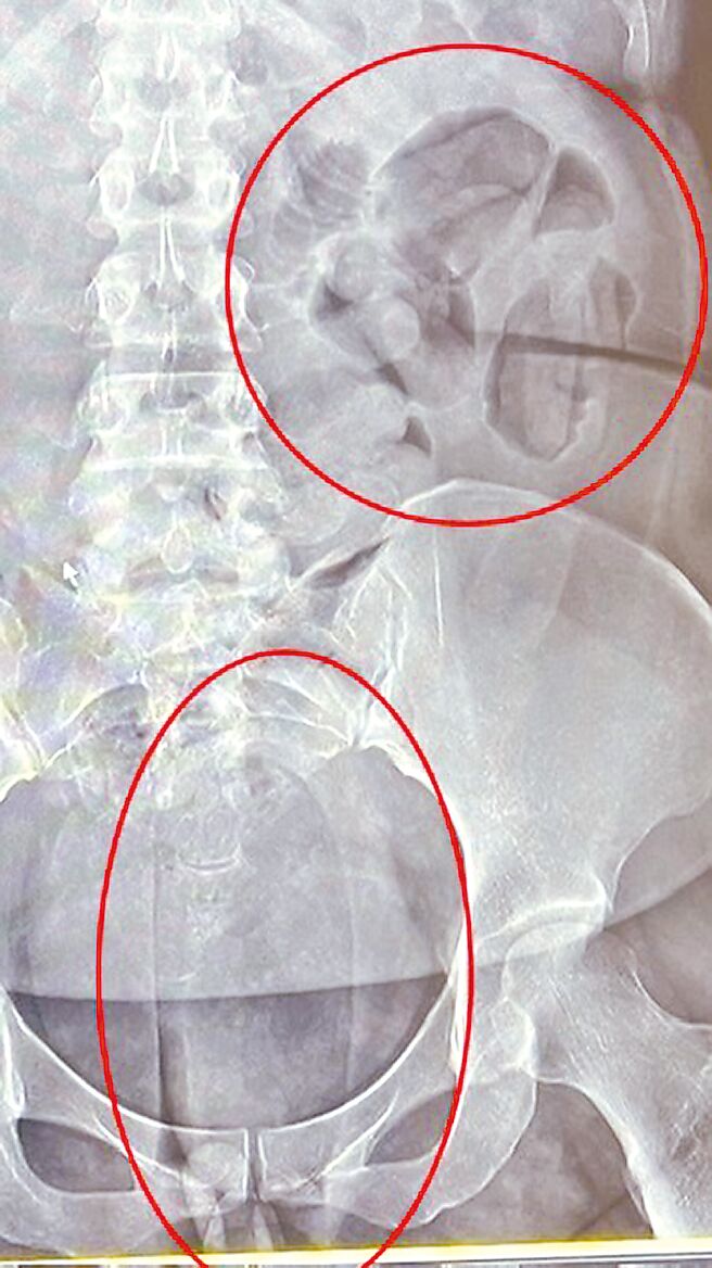 警政署保三总队查获贩毒集团以人体运毒方式，夹带5公斤海洛因与古柯碱等毒品，市值约3500万元。图为夹带毒品Ｘ光照。（保三总队提供／徐佑升基隆传真）