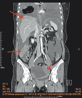 腹腔內熱化療 高溫滅殺卵巢癌細胞