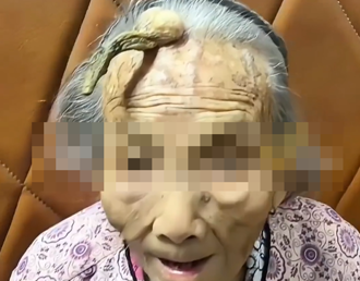 長壽角？107歲陸老奶奶「額頭長角」 原因曝光：疾病表現