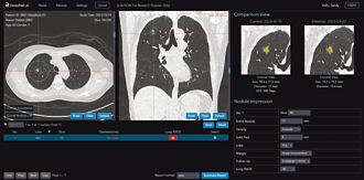 神瑞人工智慧DeepLung-CAC平台 上市