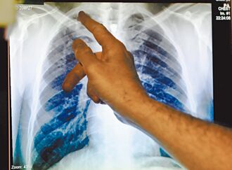 WHO：結核病 頭號傳染病殺手