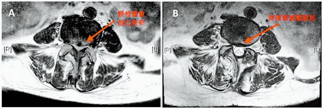 核磁共振追蹤檢查顯示，術前李先生被診斷為第四、五腰椎嚴重退化狹窄；術後1年後顯示脊椎管已完全減壓膨起。（蔡松航醫師提供／李念庭台北傳真）