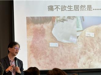 止痛藥年使用破9億錠 專家教你幾招減少依賴