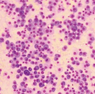 健保署引进美国CAR-T 有望用于多发性骨髓瘤