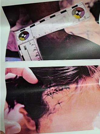 女童遭秋田犬咬到全身是血惡夢連連  飼主不聞不問母怒提告