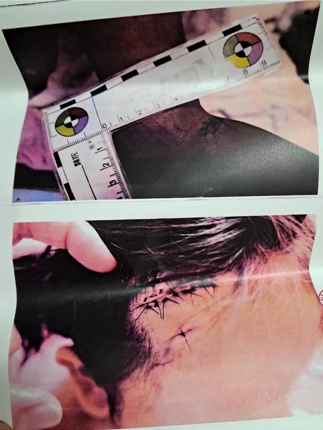 云林县7岁女童遭邻居秋田犬攻击，头、脸被咬破全身是血，送医后捡回一条命，事后女童心里产生严重阴影，但秋田犬饲主却不闻不问，女童母亲气不过，决定对饲主提告。（民眾提供／张朝欣云林传真）