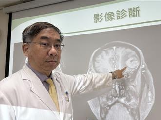 醫曝韓劇「腦癌催淚梗」真相！膠質母細胞瘤難根治 平均餘命僅半年